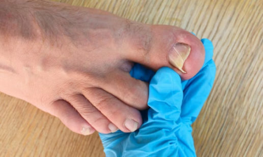 ongle incarné soins infirmiers inzee.care